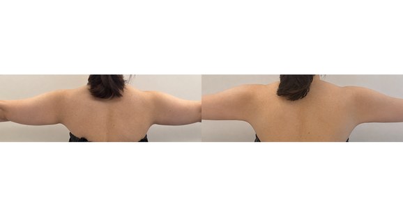 二の腕 脂肪溶解注射