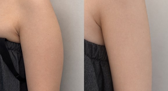 二の腕 脂肪溶解注射